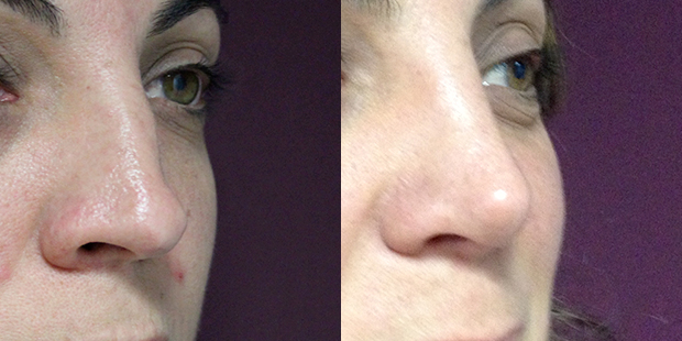 rinoplastia cerrada