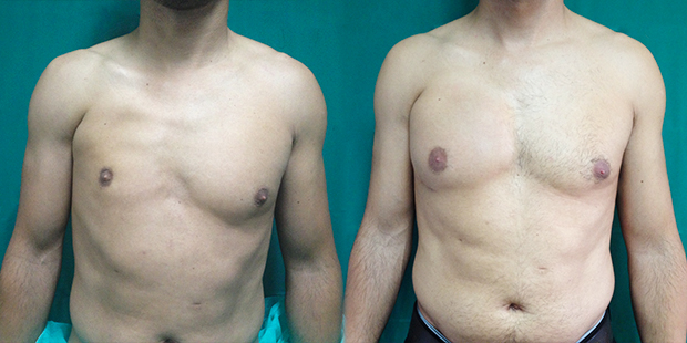 Corrección con implante pectoral + grasa