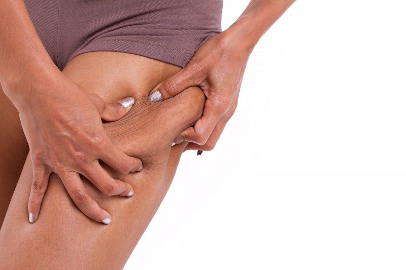 Eliminar la celulitis definitivamente