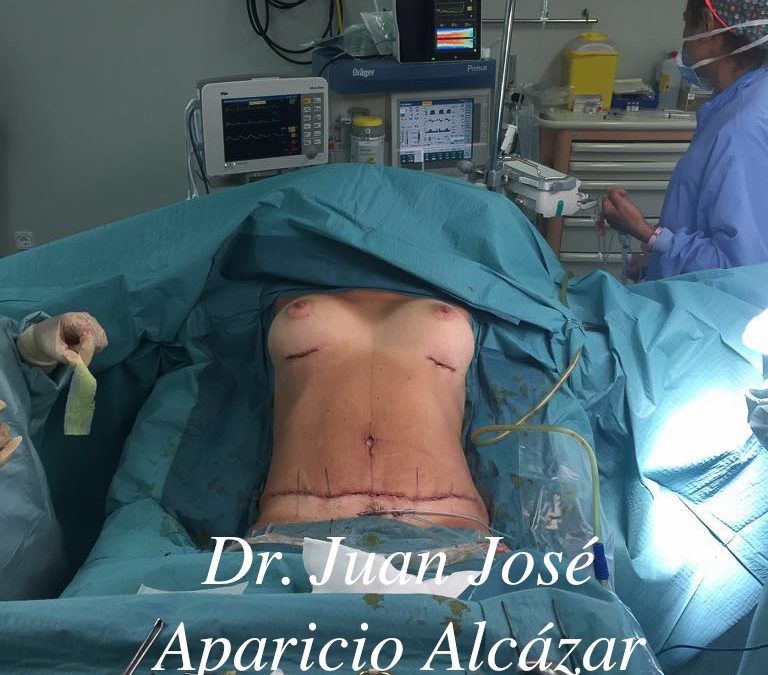 Aumento de pecho y abdominoplastia, una combinación excelente.