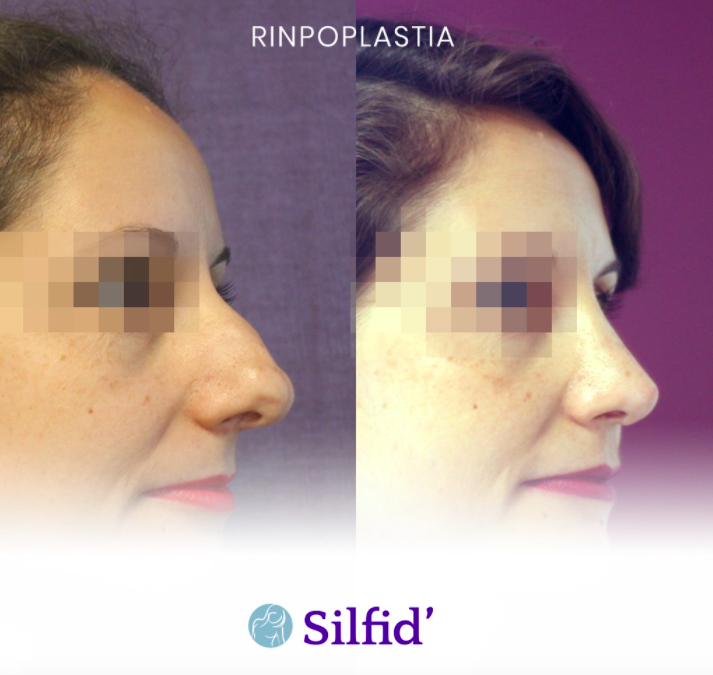 Rinoplastia ultrasónica Alicante