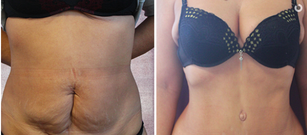 abdominoplastia